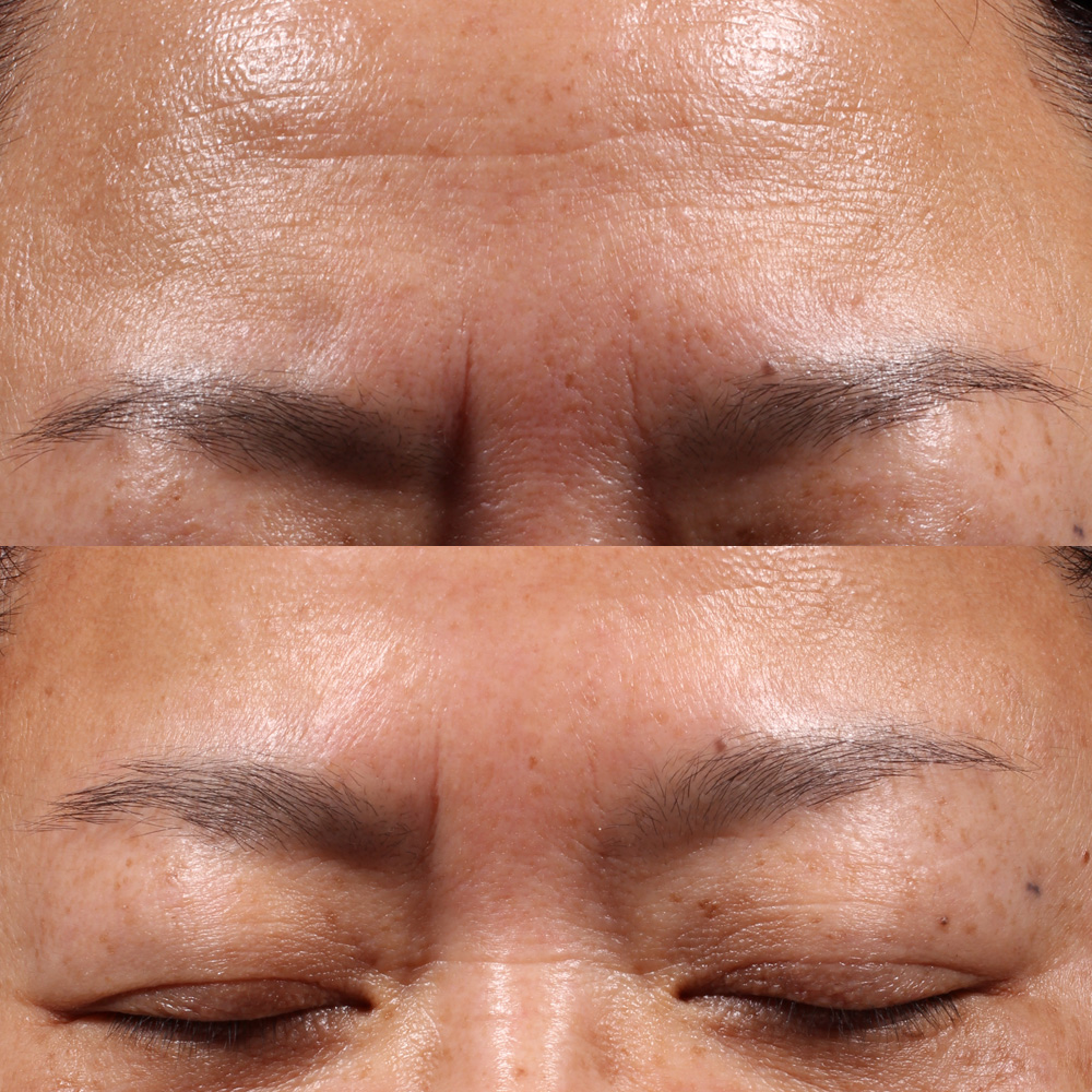 Kuva ihosta NEOSTRATA Retinol Peel -kuorinnan jälkeen – näkyviä tuloksia.